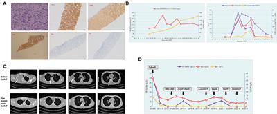 Successful Treatment of Relapsed/Refractory Extramedullary Multiple Myeloma With Anti-BCMA CAR-T Cell Therapy Followed by Haploidentical Hematopoietic Stem Cell Transplantation: A Case Report and a Review of the Contemporary Literature